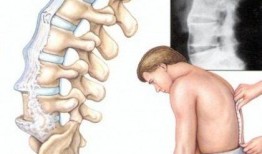 得强直性脊柱炎的明星