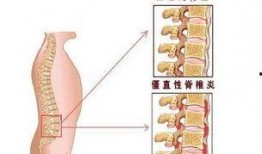 得强直性脊柱炎的明星